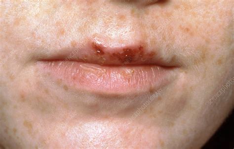 Cold Sores Stock Image C0365844 Science Photo Library