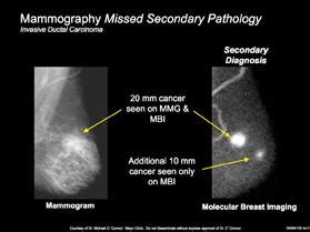 Check spelling or type a new query. The Benefits of Molecular Breast Imaging vs. Mammography ...