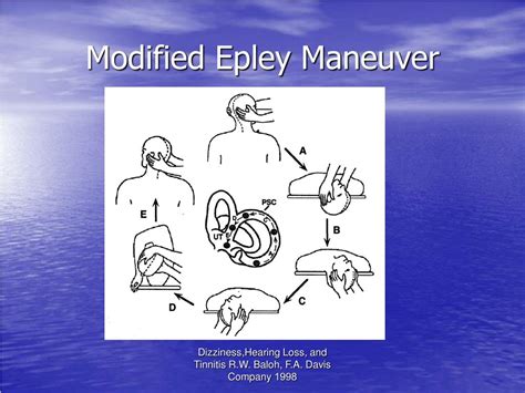 Epley Maneuver Image