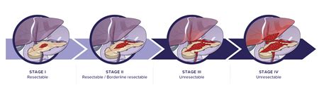 The Stages Of Pancreatic Cancer Immunovia
