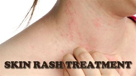 Skin Rash Treatment How To Treat Itchy Skin Rash Naturally YouTube