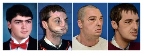 woman see s dead brothers face on another man after face transplant surgery