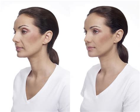 Cheek Augmentation With Dermal Fillers Non Surgical Procedure