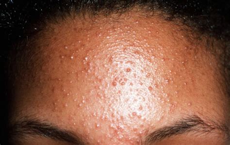 Fungal Acne What Is It And How To Treat It Moisture Plus Skincare