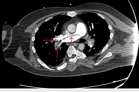 Ct Angiography Of The Chest With Intravenous Contrast Shows Saddle
