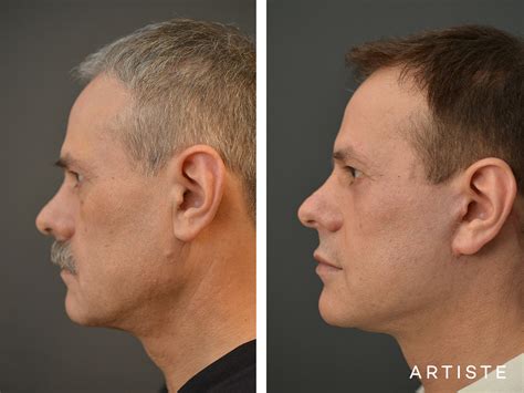 5 reasons men get a facelift artiste plastic surgery