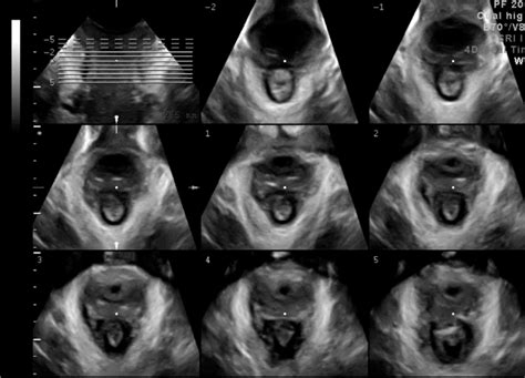Above Tomographic Ultrasound Imaging Assessment Of The Levator Ani