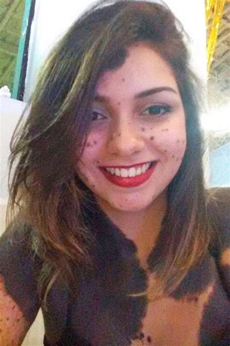 Beatriz Pugliese Shares How Shes Learned To Love Her Birthmark After