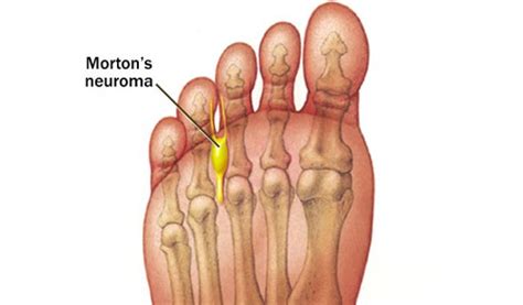 Toe Pain Cottesloe Podiatry Clinic Perth General Foot Care