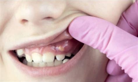 Gum Disease Tips To Prevent It And Symptoms