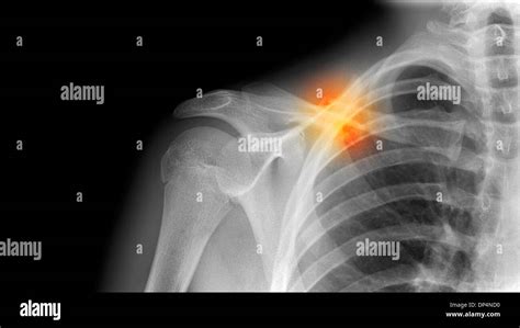 Fractured Collarbone X Ray Stock Photo Alamy