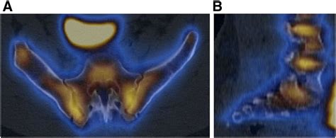 Increased Sacral Uptake On A Bone Scan With Spectct In A Patient With