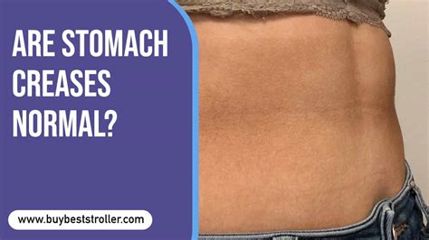 How To Get Rid Of Stomach Crease Lines