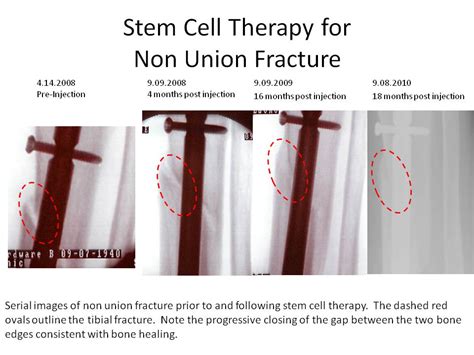Stem Cell Therapy For Non Union Fractures 2 Stem Cell Blog