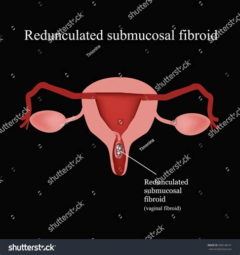 Pedunculated Submucous Uterine Fibroids Vaginal Fibroids Stock Illustration Shutterstock