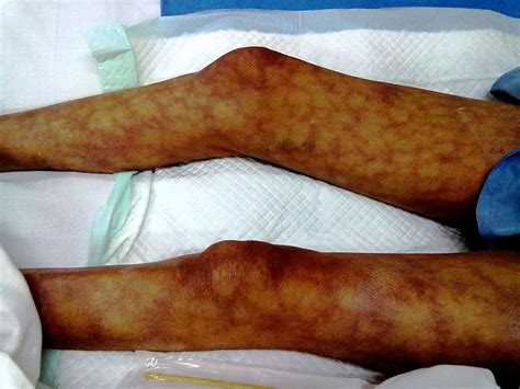 Livedo Reticularis Heralding Hypercalcaemia Of Malignancy Bmj Case