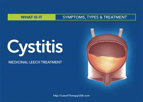 Cystitis Treatment In Philadelphia Pa