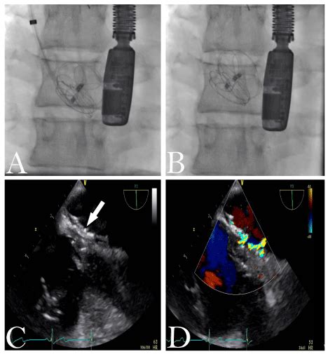 Percutaneous Transcatheter Patent Foramen Ovale Closure With A Gore