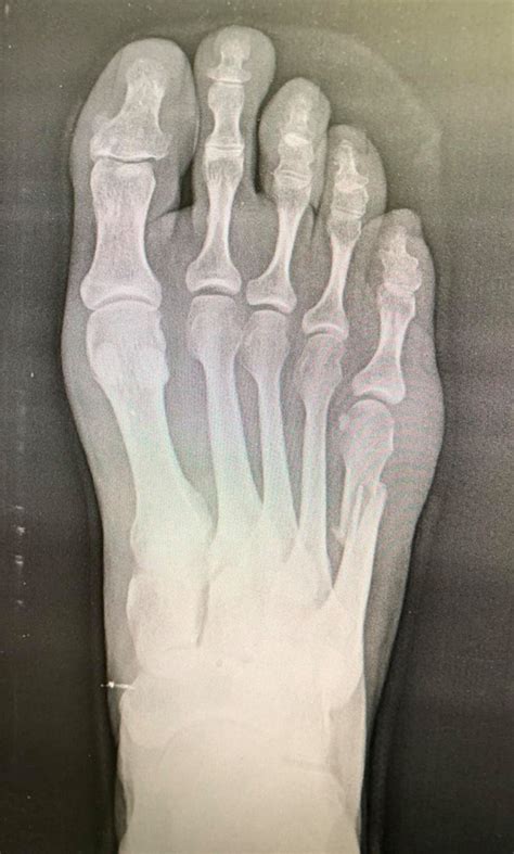 Fifth Metatarsal Fracture Orthopaedic Specialists Of Louisville