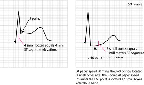 Reciprocal st depression and pr elevation in avr and v1; Figure 14. Example of measuring ST-deviation. - ECG learning
