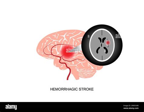 Illustration Of Basal Ganglia Cerebral Hemorrhagic Stroke And Ct Brain