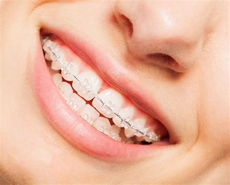 Clear Braces What You Need To Know Fidt