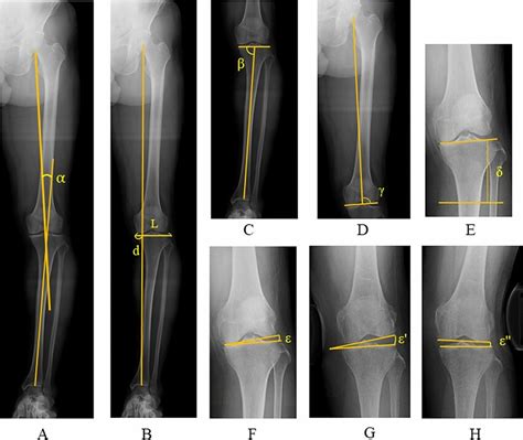Radiographic Assessments A Mechanical Leg Axis Angle The Angle
