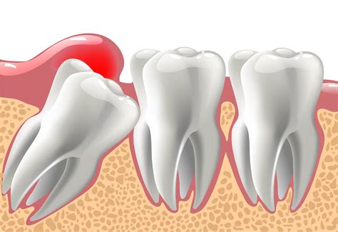Things You Need To Know About Wisdom Tooth Infection And Complications