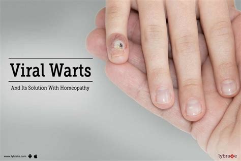 Viral Warts And Its Solution With Homeopathy By Dr Naitik Shah Lybrate