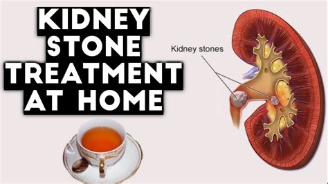 Quick Kidney Stone Treatment At Home Youtube