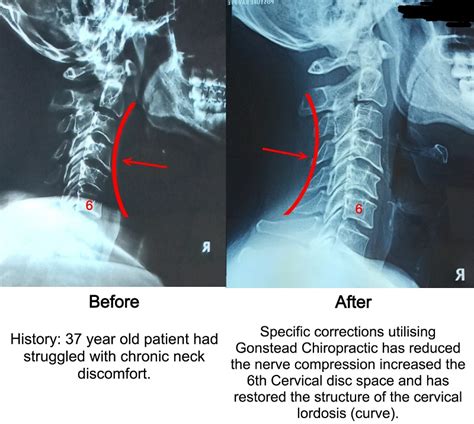 Restoration Of Cervical Curve A Chiropractic Clinic Utilizes Gonstead