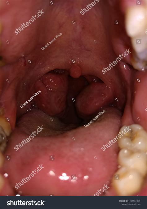 Swollen Tonsils Inside Mouth Tonsillitis Patient Stock Photo 1104561959