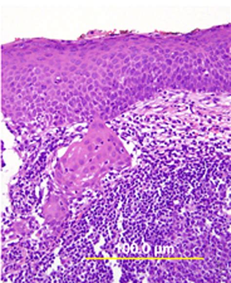 Pathology Of Cervical Carcinoma Glowm