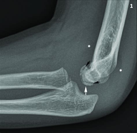 Conventional Radiography Of The Right Elbow Lateral View The
