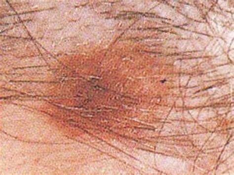 Melanoma The Deadliest Skin Cancer Skin Cancer Or Mole How To Tell Cbs News