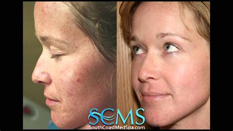 Laser Acne Scar Removal Beforeafter Female Fair Skin Youtube