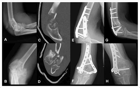 An 83 Year Old Female Sustained A Comminuted Intra Articular Distal