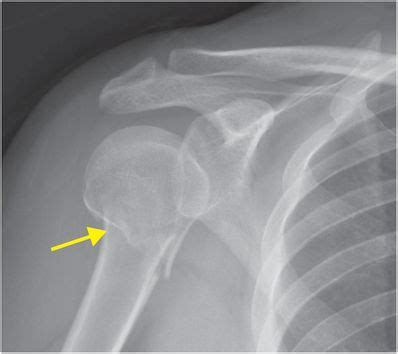 Proximal Humerus Fracture X Ray