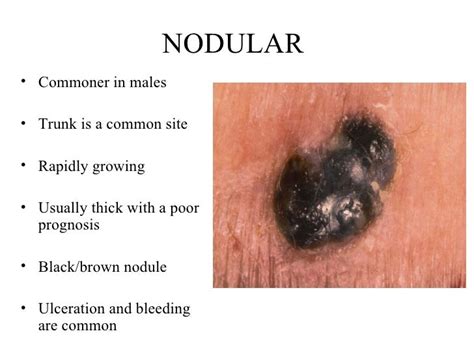 Nodular Melanoma Symptoms Doctor Heck
