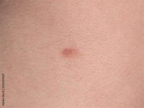 Picture Of A Male Torso With A Third Nipple Close Up Supernumerary Nipple Stock Photo