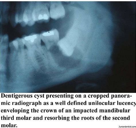 Dentigerous Cyst Definition Clinical Features Types Radiographic