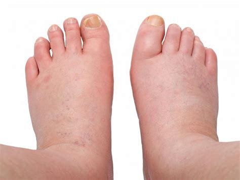 Is There A Connection Between Amlodipine And Edema