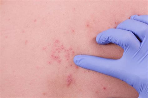 Conditions Mistaken For Shingles Herpes Zoster