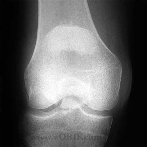 Patella Fracture Orif 27524 Eorif