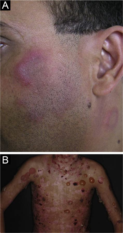A Lupus Erythematosus Tumidus Arciform And Annular Erythemato