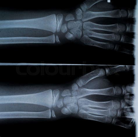 X Ray Of Two Hands And Forearm Stock Image Colourbox