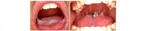 Pws Patients Present Thickened Sticky Saliva See The Clinical