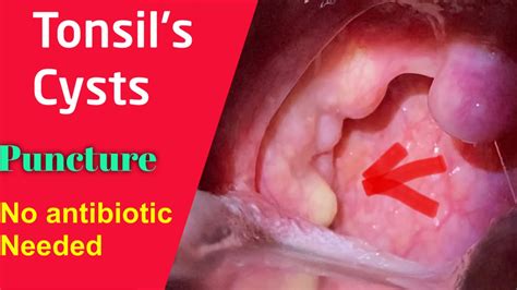 Tonsil Cyst White Thing Over Tonsil Symptoms And Management No