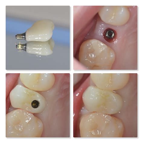 Implant Stages At Infinity Dental Clinic Infinity Dental Clinic