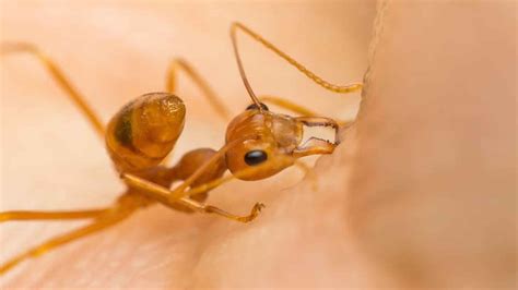 Ant Bites And Stings Symptoms Diagnosis Treatment And Prognosis